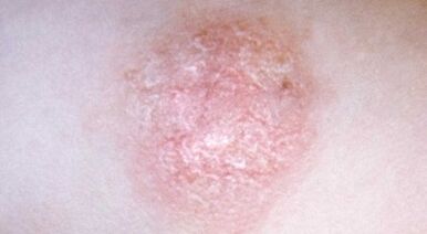 Comment détecter le psoriasis à un stade précoce
