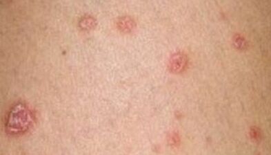 Photo du psoriasis aux premiers stades