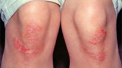 Principales manifestations du psoriasis