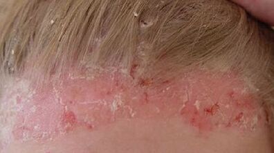 Stades de développement et symptômes du psoriasis