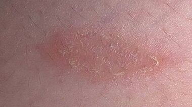 comment et avec quoi traiter le psoriasis