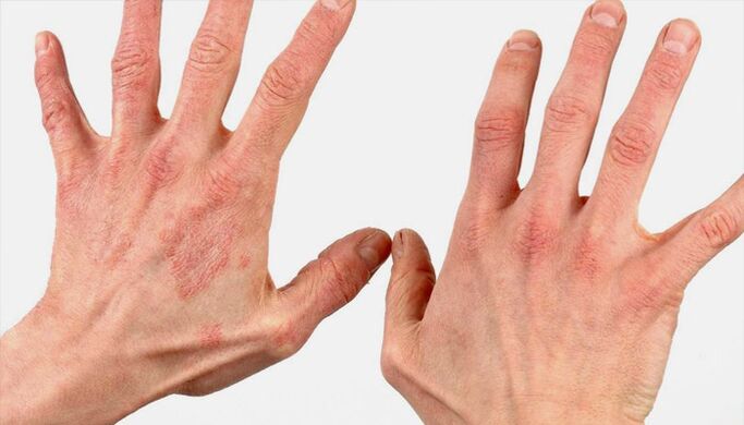 Méthodes de traitement du psoriasis avec des remèdes populaires
