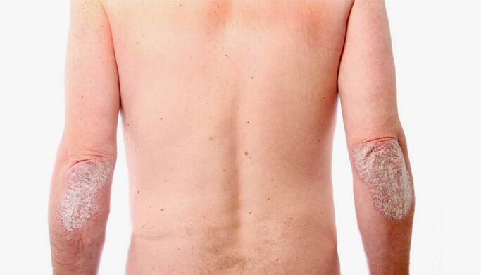 Remèdes populaires pour le traitement du psoriasis