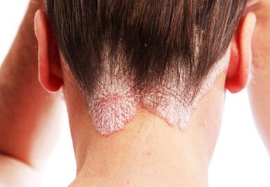 Psoriasis sur la tête