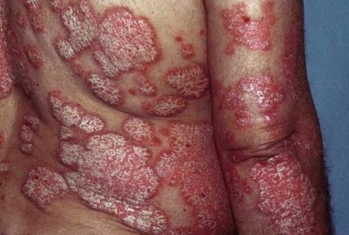 psoriasis