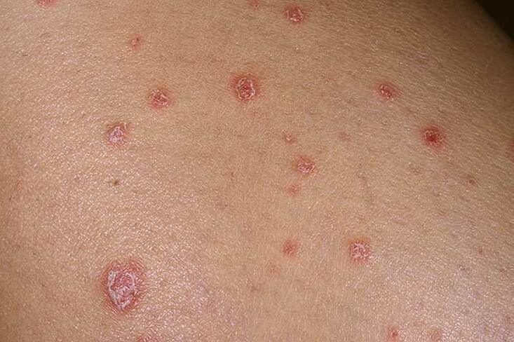 Les causes du psoriasis