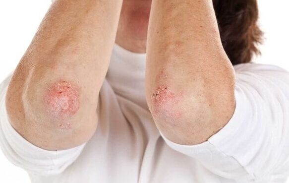 psoriasis