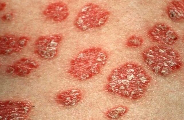 Papules psoriasis