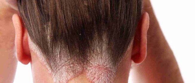 Psoriasis de la tête