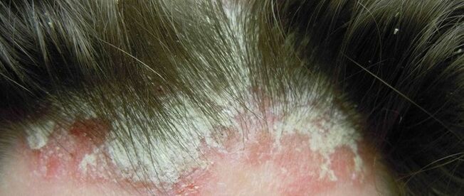 Psoriasis sur la tête
