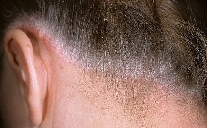 Psoriasis dans les cheveux