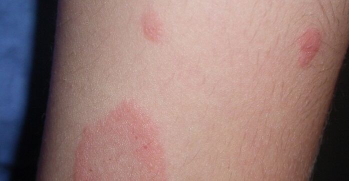 psoriasis