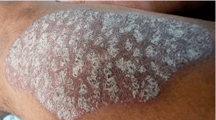 Pathogenèse du psoriasis
