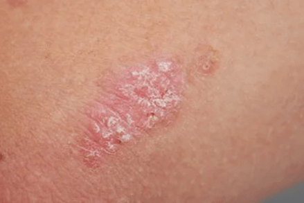 Psoriasis - Étape initiale