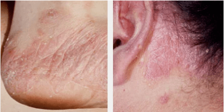 Types de psoriasis