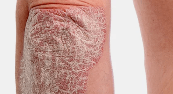 psoriasis