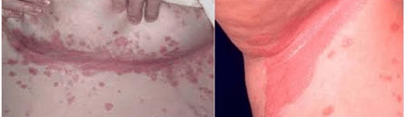 Forme atypique du psoriasis
