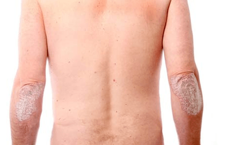 Symptômes généraux du psoriasis