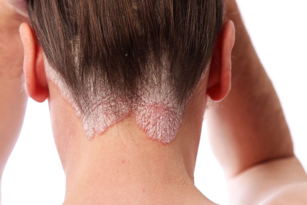 Traitement du psoriasis