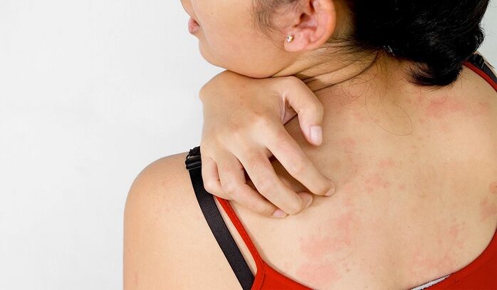 Psoriasis sur le dos