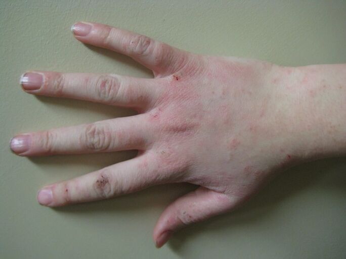 Psoriasis à un stade précoce