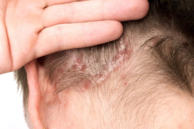 Aggravation du psoriasis sur la tête
