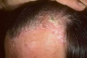 Posriasis sur le cuir chevelu