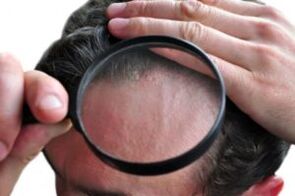 Psoriasis sur la tête à travers une loupe