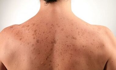 Raisons du développement du psoriasis