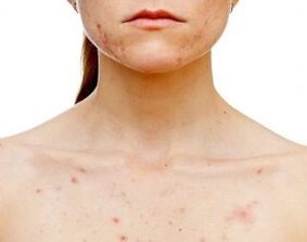 Où sur le corps apparaît le psoriasis 