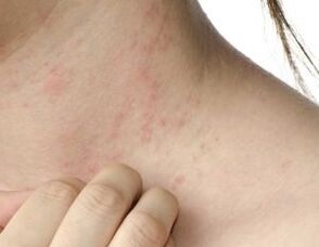 Principaux symptômes du psoriasis
