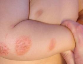Symptômes du psoriasis chez les enfants