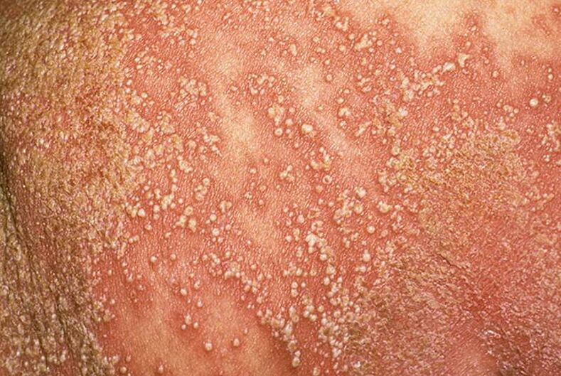 Psoriasis pustuleux