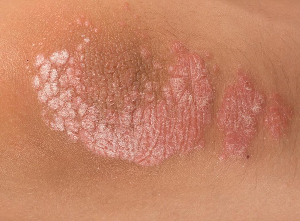 psoriasis
