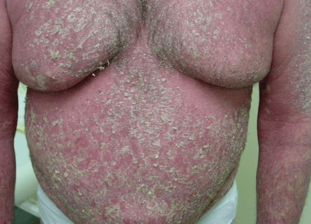 Érythrodermie psoriasique sur le corps