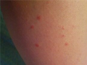 Psoriasis sur la peau